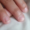 爪の変形の原因とは？病気や治療方法の紹介！